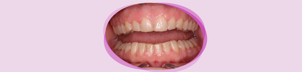 Bruxism și ATM - legătura pe care nu o știai