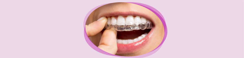Invisalign Timișoara - cum funcționează, pentru cine e potrivit și la ce să te aștepți